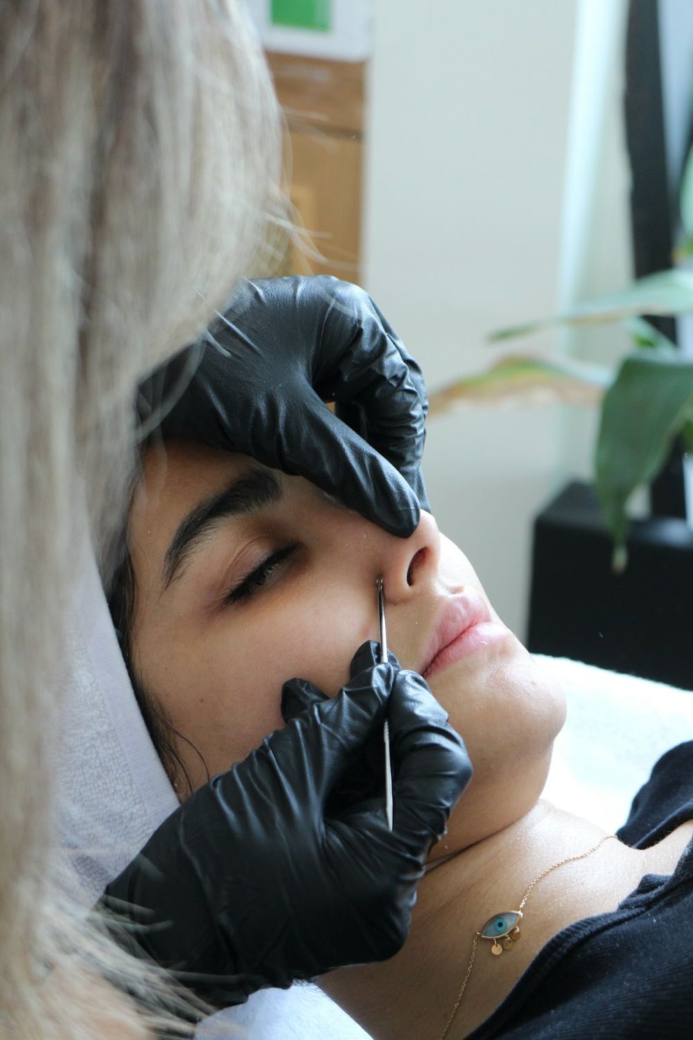 Rhinoplasty